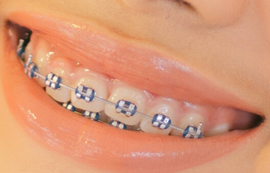 Why Choose Agrim Dental for Orthodontic Treatment in Kathmandu?