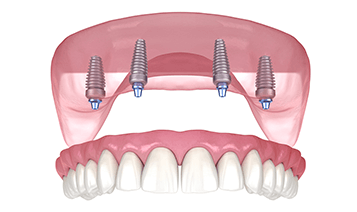 All-on-4 and All-on-6 Implants