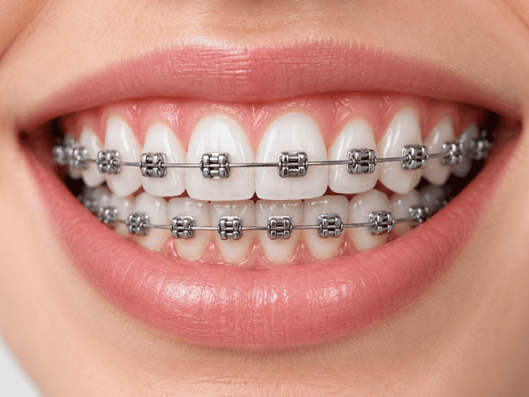 Metal braces for orthodontic treatment at Agrim Dental Clinic